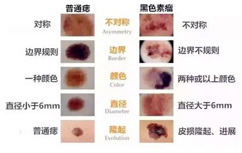 痣是怎麼形成的